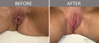 Labiaplasty Before & After Gallery - Patient 90704979 - Image 1