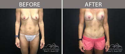 Abdominoplasty Before & After Gallery - Patient 90704989 - Image 1