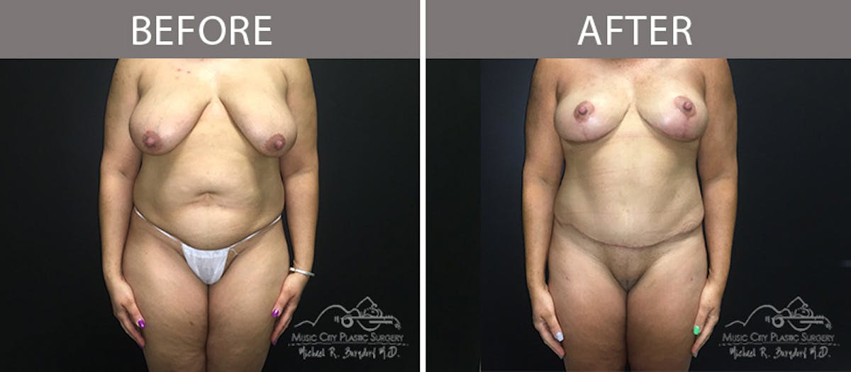 Liposuction Before & After Gallery - Patient 90704987 - Image 1