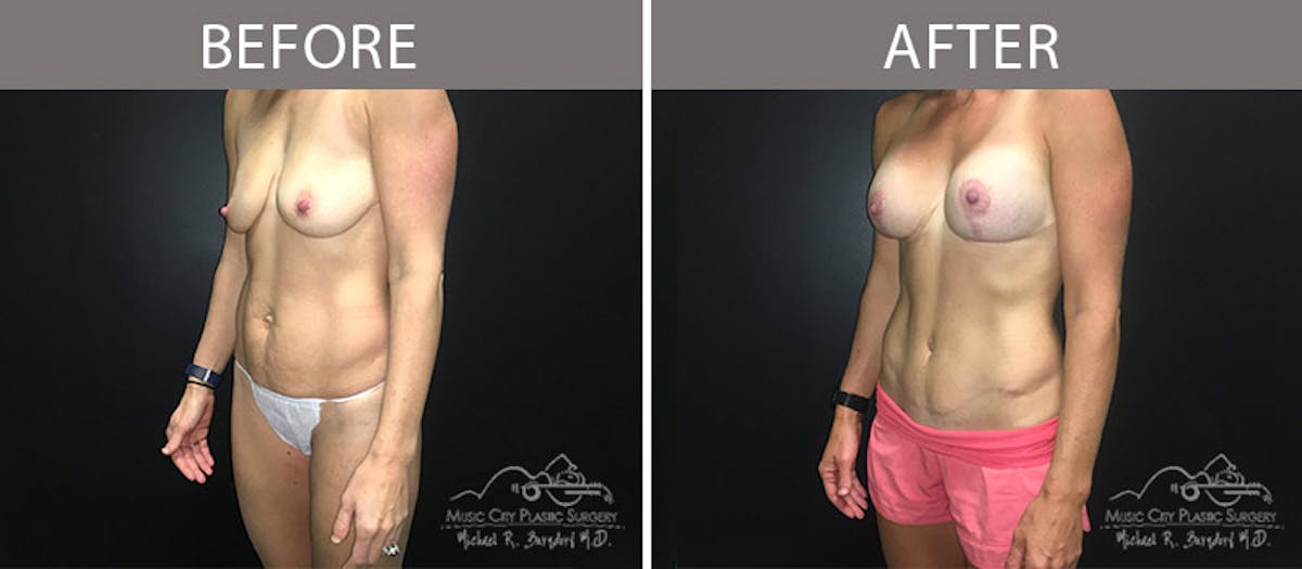 Abdominoplasty Before & After Gallery - Patient 90704989 - Image 2