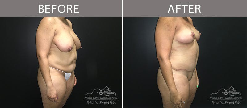 Liposuction Before & After Gallery - Patient 90704987 - Image 4