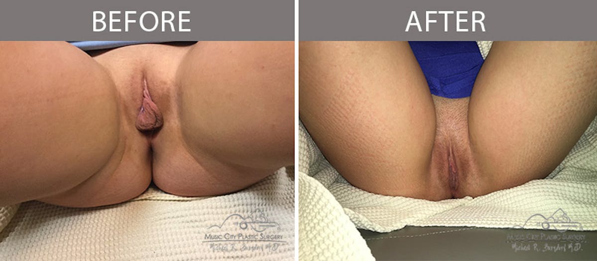 Labiaplasty Before & After Gallery - Patient 90704985 - Image 1