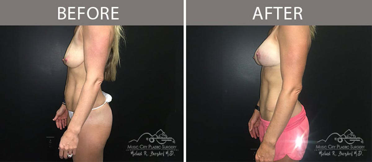 Abdominoplasty Before & After Gallery - Patient 90704989 - Image 3