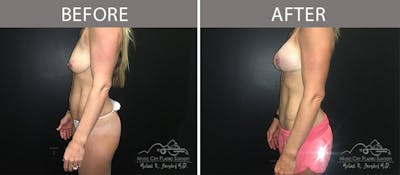 Abdominoplasty Before & After Gallery - Patient 90704989 - Image 3