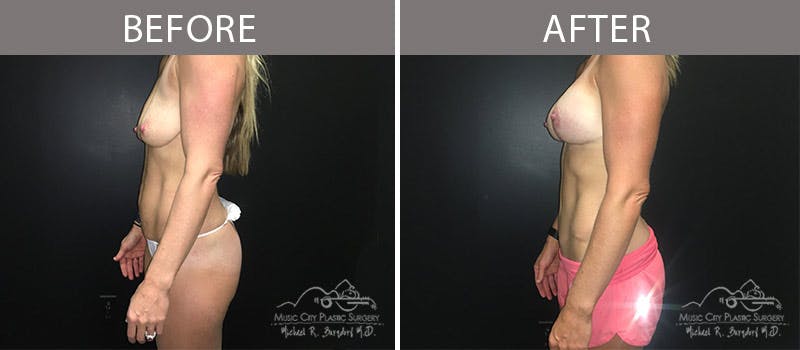 Abdominoplasty Before & After Gallery - Patient 90704989 - Image 3