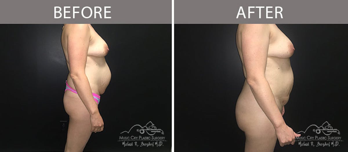 Brazilian Butt Lift Before & After Gallery - Patient 90704986 - Image 3
