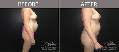 Brazilian Butt Lift Before & After Gallery - Patient 90704986 - Image 3
