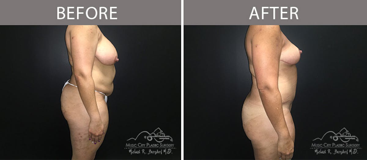 Liposuction Before & After Gallery - Patient 90704987 - Image 5