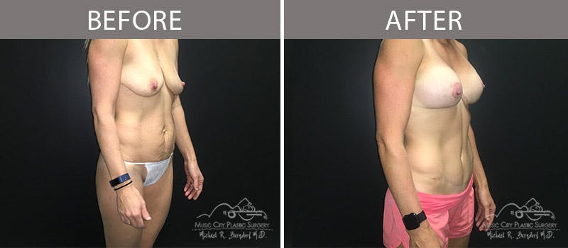 Abdominoplasty Before & After Gallery - Patient 90704989 - Image 4