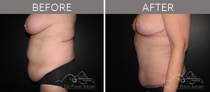 Mommy Makeover Before & After Gallery - Patient 90705018 - Image 1