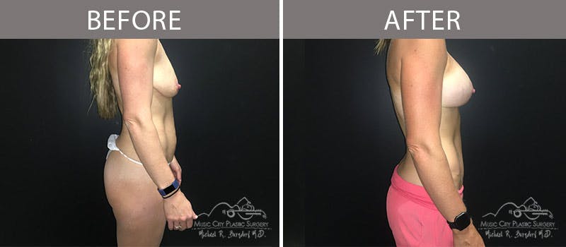 Abdominoplasty Before & After Gallery - Patient 90704989 - Image 5