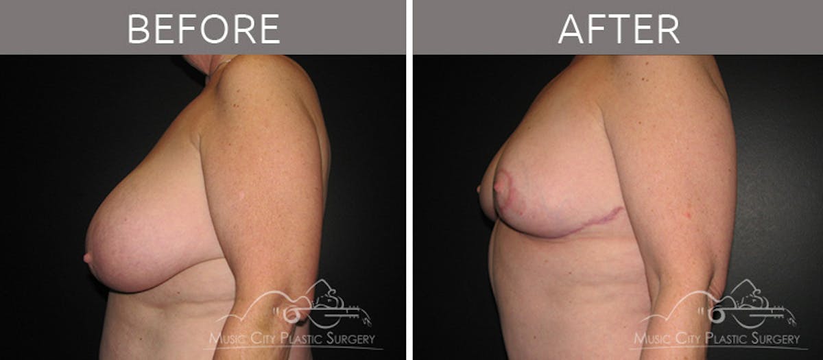 Mommy Makeover Before & After Gallery - Patient 90705018 - Image 3