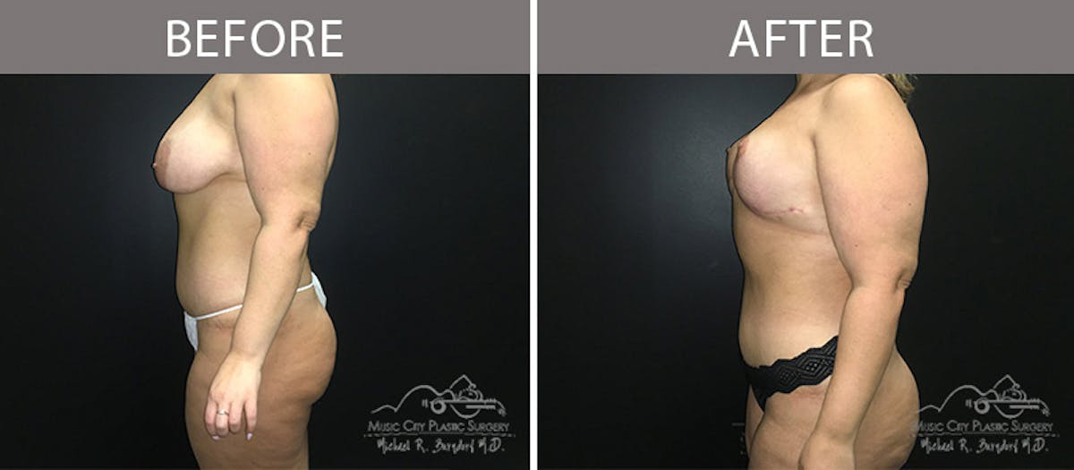 Liposuction Before & After Gallery - Patient 90705004 - Image 3