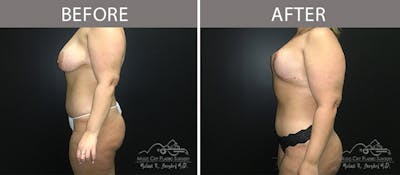 Liposuction Before & After Gallery - Patient 90705004 - Image 1