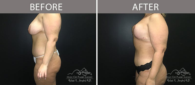 Liposuction Before & After Gallery - Patient 90705004 - Image 1