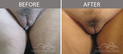 Labiaplasty Before & After Gallery - Patient 90704995 - Image 1