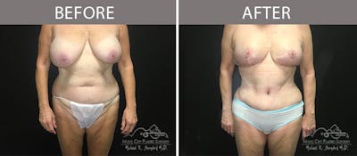Abdominoplasty Before & After Gallery - Patient 90705007 - Image 1