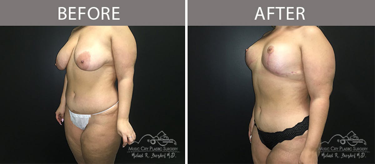 Liposuction Before & After Gallery - Patient 90705004 - Image 2