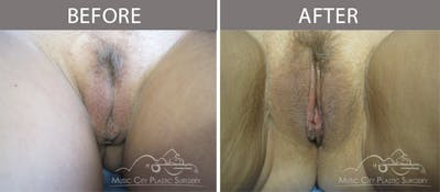 Labiaplasty Before & After Gallery - Patient 90704995 - Image 2