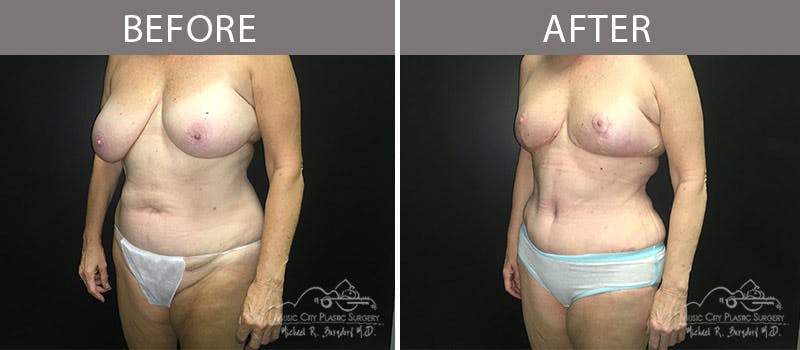 Abdominoplasty Before & After Gallery - Patient 90705007 - Image 2