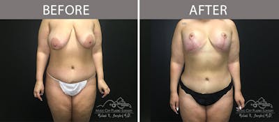 Liposuction Before & After Gallery - Patient 90705004 - Image 1