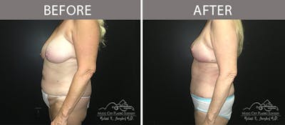 Abdominoplasty Before & After Gallery - Patient 90705007 - Image 3