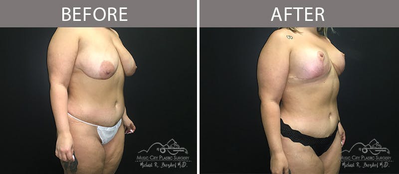 Liposuction Before & After Gallery - Patient 90705004 - Image 4