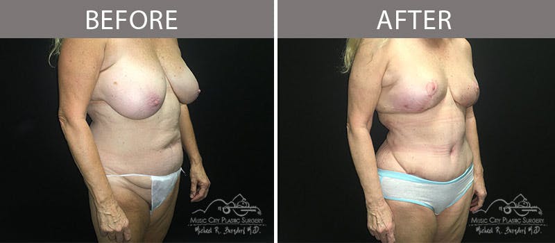 Abdominoplasty Before & After Gallery - Patient 90705007 - Image 4