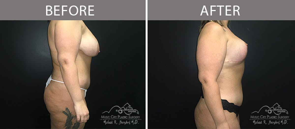 Liposuction Before & After Gallery - Patient 90705004 - Image 5