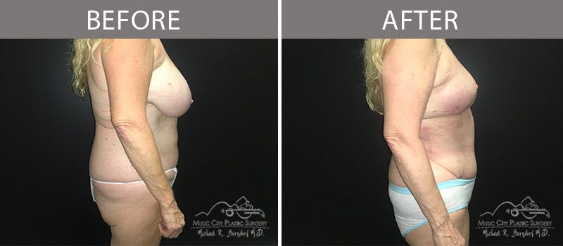 Abdominoplasty Before & After Gallery - Patient 90705007 - Image 5
