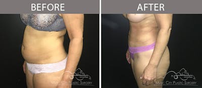 Liposuction Before & After Gallery - Patient 90705015 - Image 2