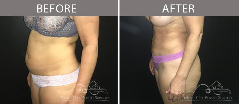 Liposuction Before & After Gallery - Patient 90705015 - Image 1