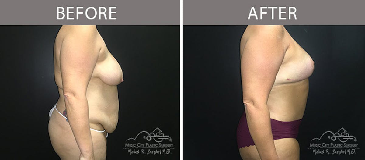 Abdominoplasty Before & After Gallery - Patient 90705019 - Image 5