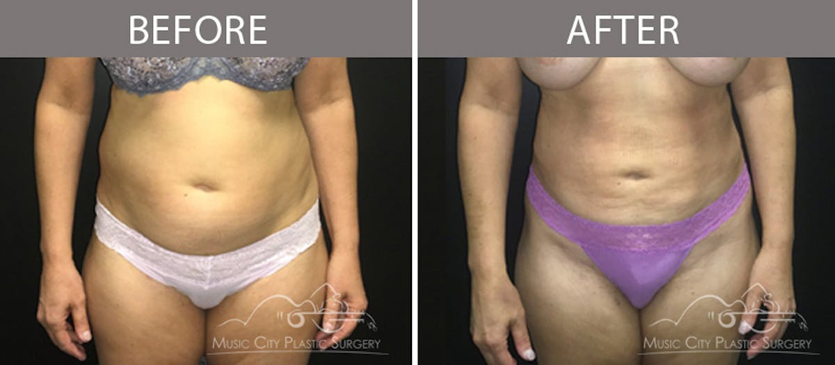 Liposuction Before & After Gallery - Patient 90705015 - Image 1