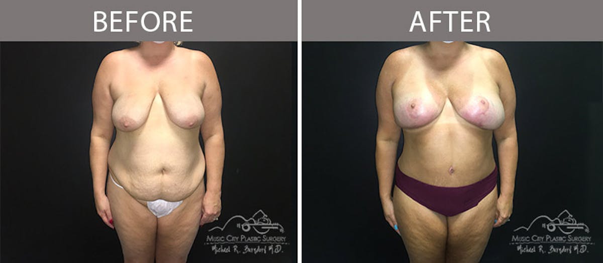 Abdominoplasty Before & After Gallery - Patient 90705019 - Image 1