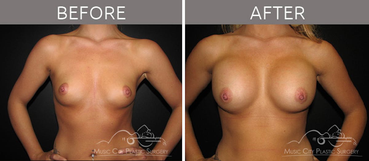 Breast Augmentation Before & After Gallery - Patient 90705020 - Image 1
