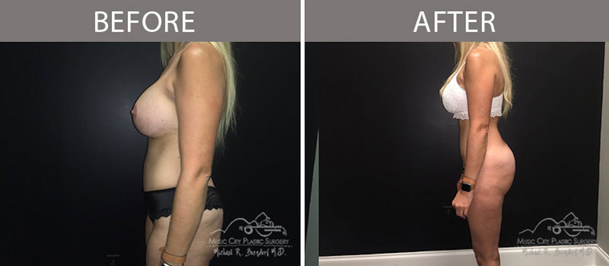 Liposuction Before & After Gallery - Patient 90705028 - Image 1