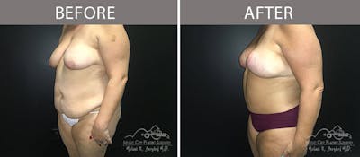 Abdominoplasty Before & After Gallery - Patient 90705019 - Image 2