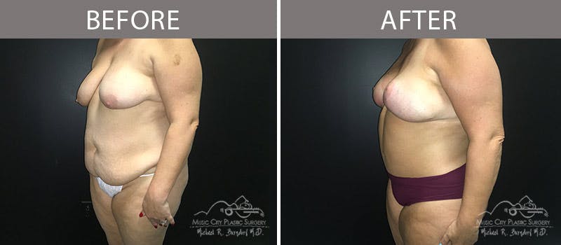 Abdominoplasty Before & After Gallery - Patient 90705019 - Image 3