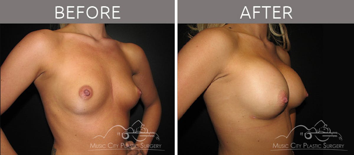 Breast Augmentation Before & After Gallery - Patient 90705020 - Image 2