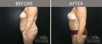 Abdominoplasty Before & After Gallery - Patient 90705019 - Image 3