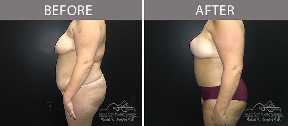 Abdominoplasty Before & After Gallery - Patient 90705019 - Image 3