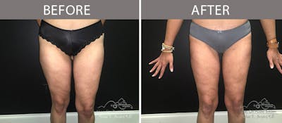 Liposuction Before & After Gallery - Patient 90705028 - Image 2