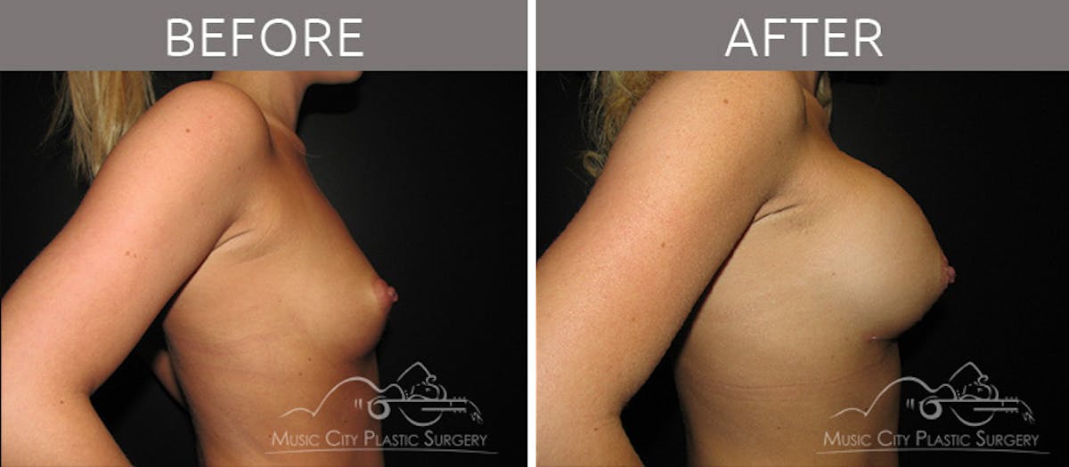 Breast Augmentation Before & After Gallery - Patient 90705020 - Image 3