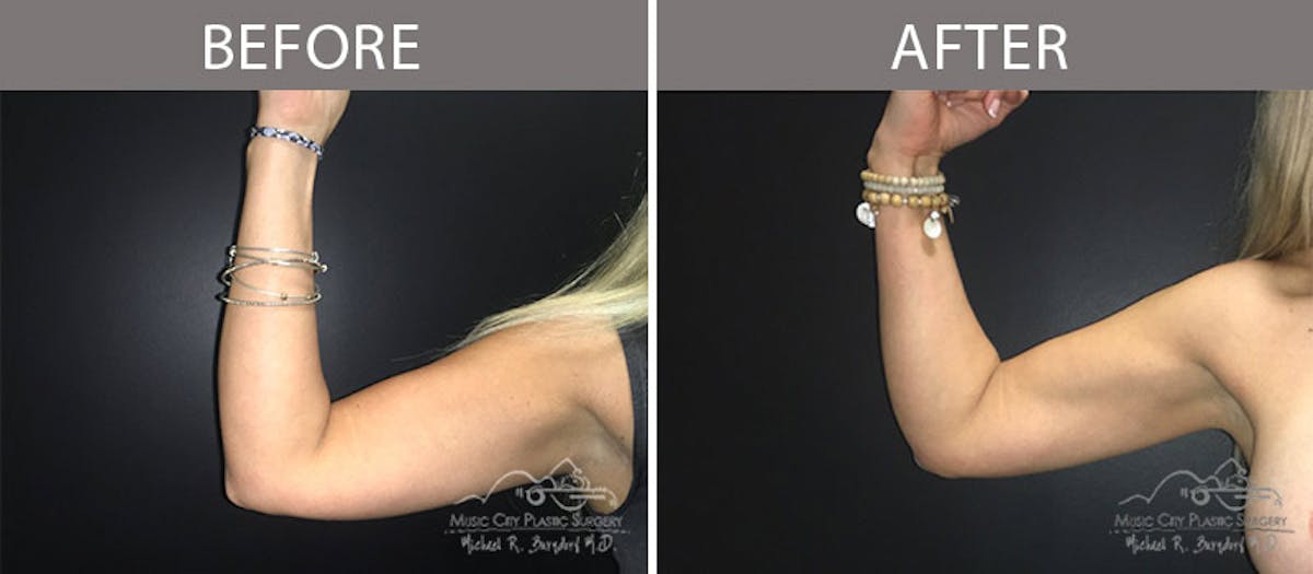Liposuction Before & After Gallery - Patient 90705028 - Image 3