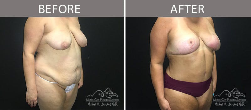 Abdominoplasty Before & After Gallery - Patient 90705019 - Image 5