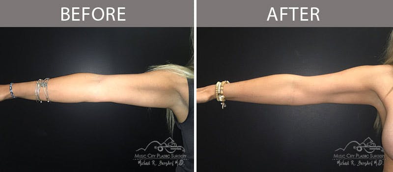 Liposuction Before & After Gallery - Patient 90705028 - Image 4