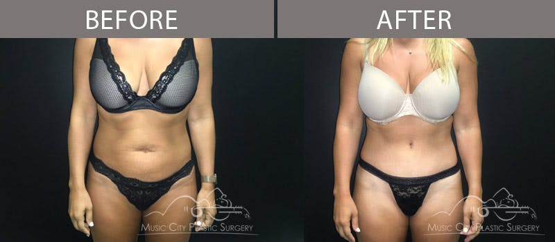 Abdominoplasty Before & After Gallery - Patient 90705031 - Image 1