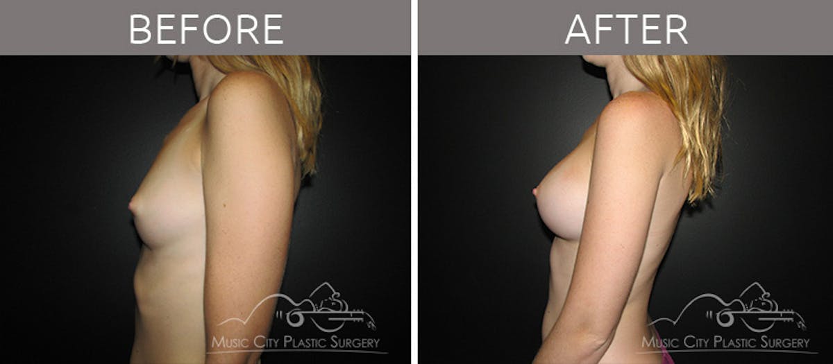 Breast Augmentation Before & After Gallery - Patient 90705034 - Image 3