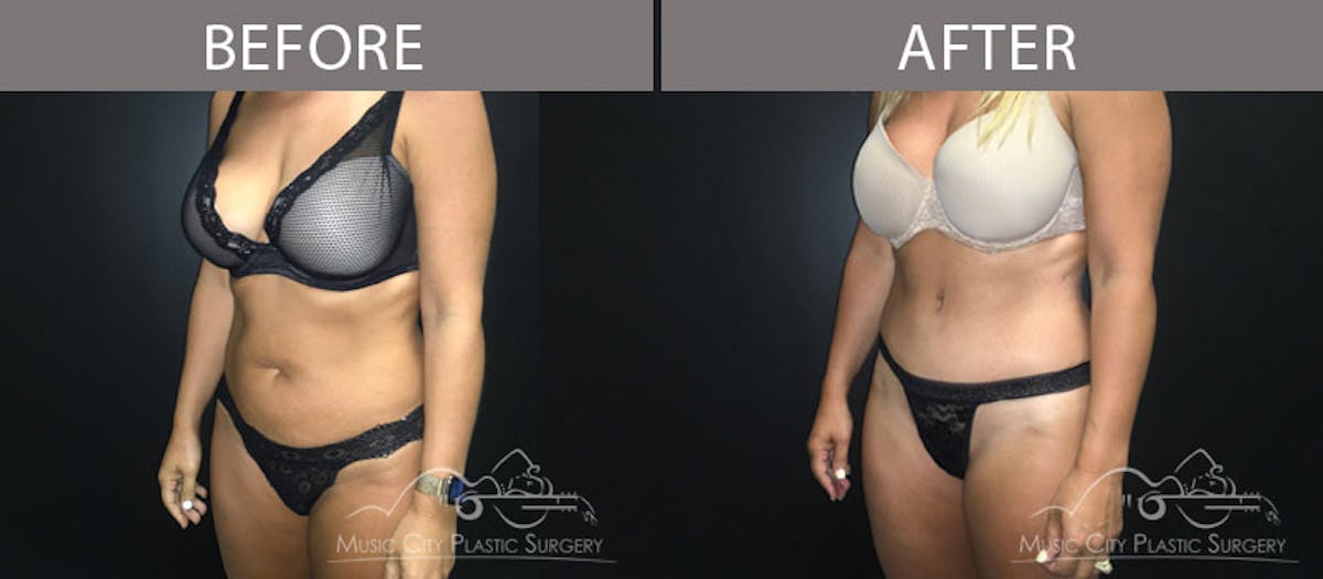 Abdominoplasty Before & After Gallery - Patient 90705031 - Image 2